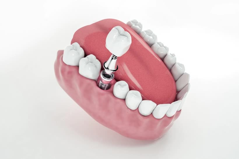 Ilustração de implante dentário unitário com coroa