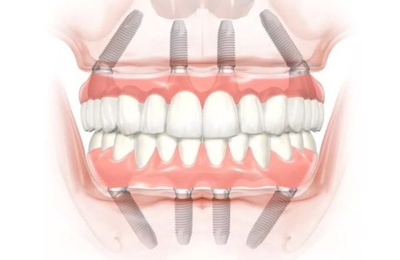 Ilustração de prótese protocolo fixa sobre implantes